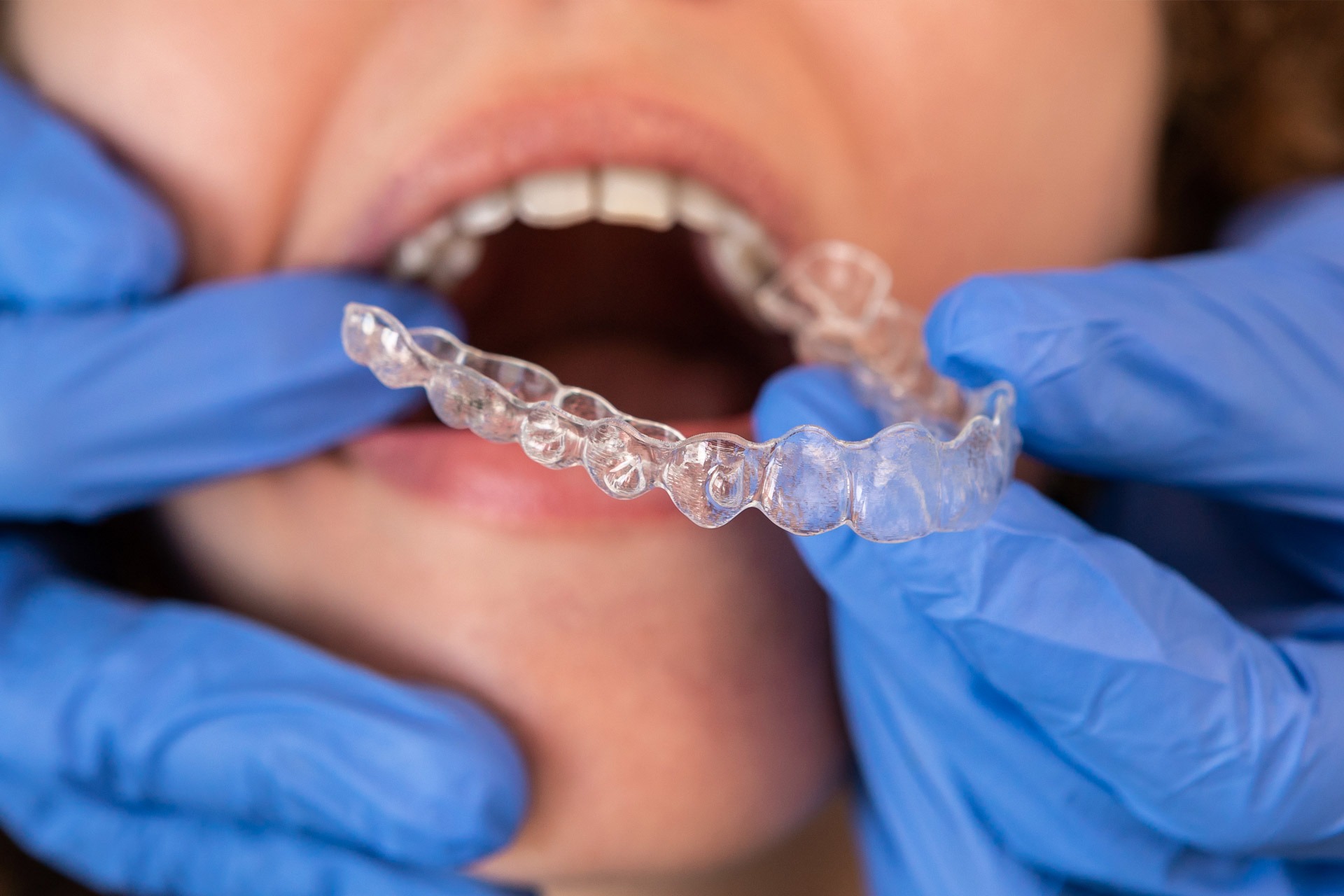 Invisible orthodontics